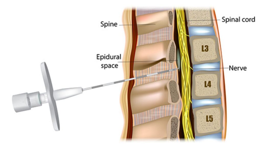 Does Insurance Cover Epidural